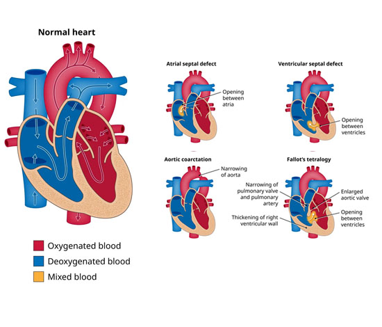Chronic Heart Disease treatment in pune,india