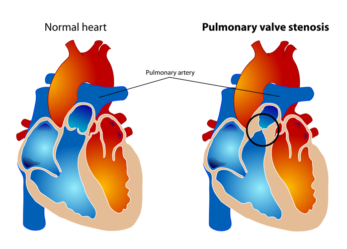  Pulmonary stenosis