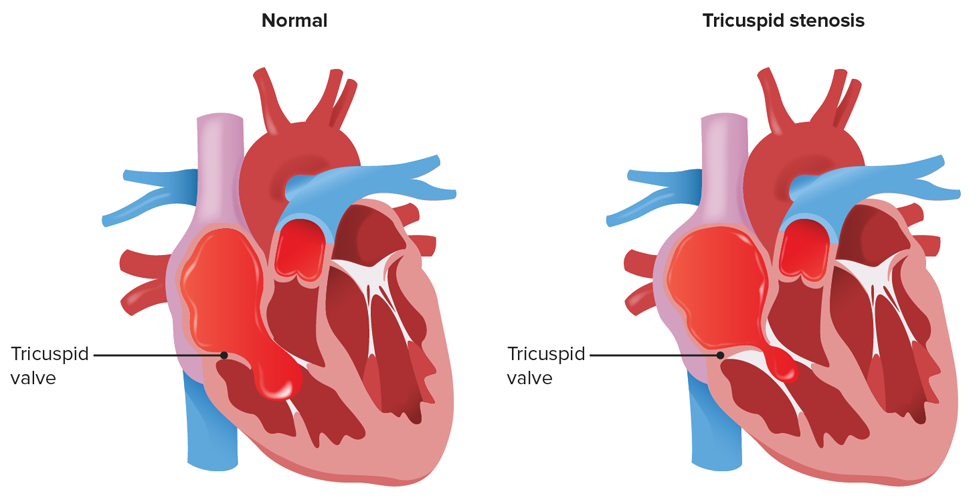 Tricuspid stenosis