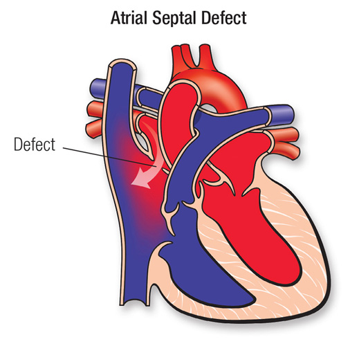 Ayurvedic Treatment on Atrial Septal Defect