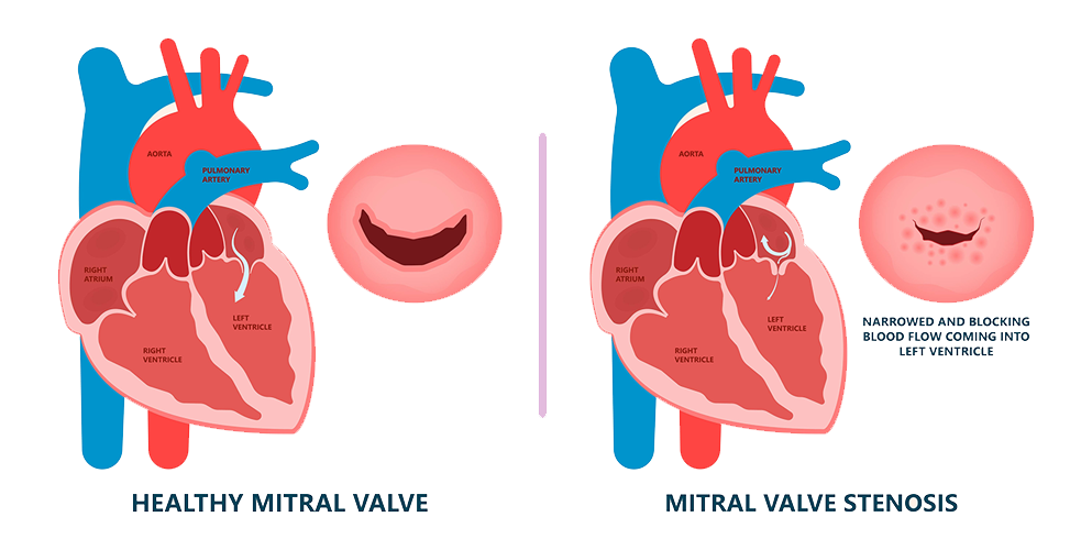 mitral valve stenosis