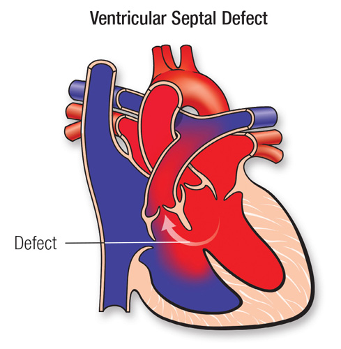 Ayurvedic Treatment on Ventricular Septal Defect,Atrial Septal Defect